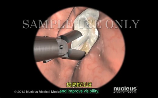 【3D医学动画】胃镜检查（中英双字幕+原版英文）