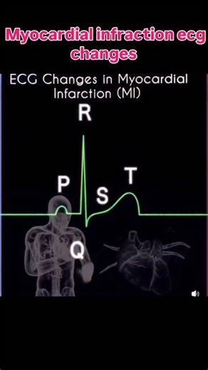 Myocardial infraction ecg changes | Ajammeel Khan