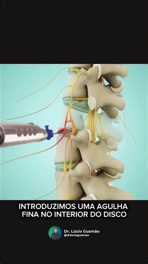 Agulha fina, imagem guiada e sem cirurgia extensa, conheça a discectomia a laser