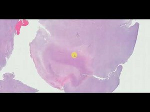 Spindle cell/sclerosing rhabdomyosarcoma