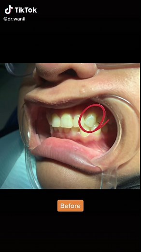 Icon Infiltration treatment for fluorosis #fyp #klinikgigijohorbahru #klinikgigijb #dental #doktorgigi #fluorosis #whiteningteeth #iconinfiltration