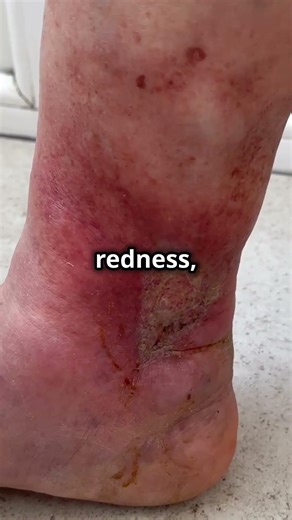 Heel Spur vs Gout! Spot the Difference & Find Relief! #shorts