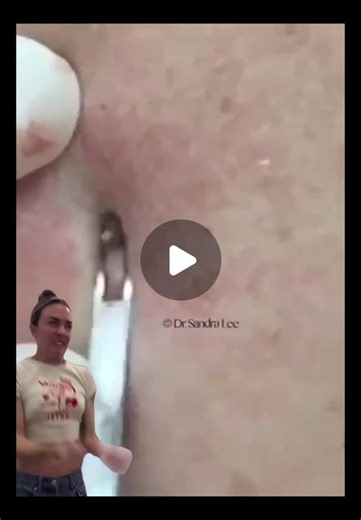 Sandra Lee, MD, FAAD, FAACS on Instagram: "This is how I picture those of you that hate when I use my comedone extractor watching my videos! Just know that I would never do anything to harm my patients and I make sure they are comfortable and I minimize the risk of permanent scarring at all times! ✌️❤️💥⁠ ⁠ #drpimplepopper #Popaholic #dermatology #comedone #comedoneextractor"