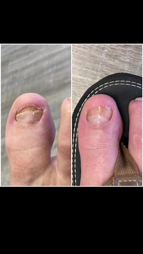How to Fix Damaged and Broken Toenails: Healing Tips