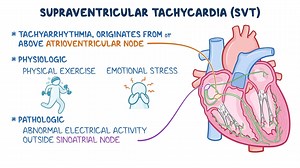 Video: Supraventricular tachycardia: Clinical sciences - Video Explanation! | Osmosis | Osmosis