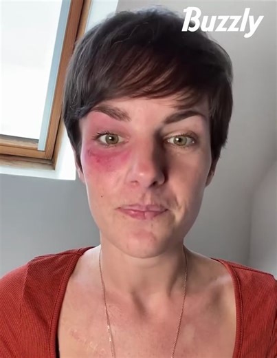 Atteinte d'algie vasculaire de la face, Diane nous raconte