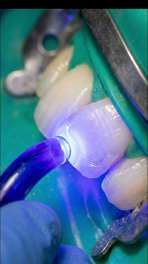 Twisted Front Tooth Optical Correction – Making a Rotated Tooth Appear Straight Using Composite
