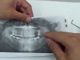Bone Graft - Sinus Augmentation - Instrumentation • Video • MEDtube.net