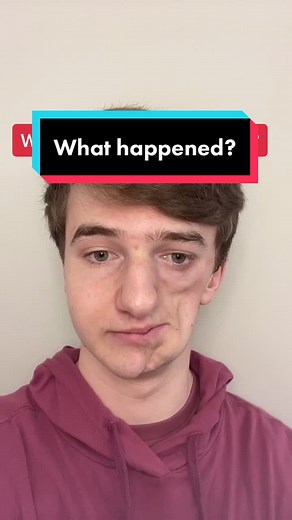 Understanding Parry Romberg Syndrome: The Story of Lukas Caldwell