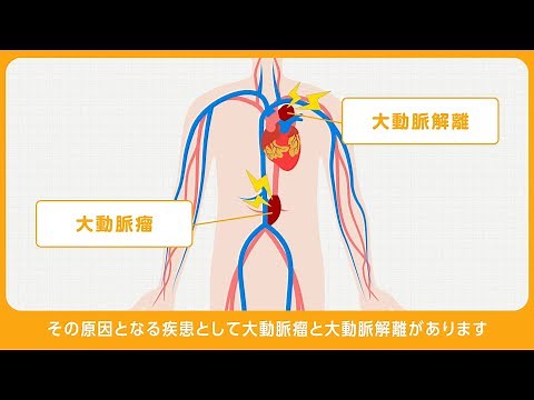 解離性大動脈瘤・胸部大動脈瘤腹部大動脈瘤（症状と対応、入院から退院まで）