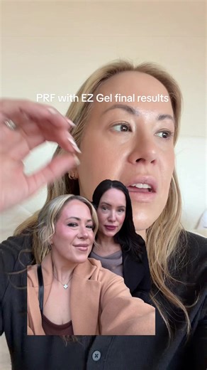 Final Results of PRF EZ Gel Undereye Treatment