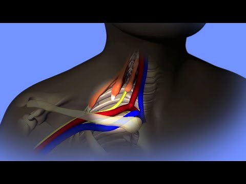 Thoracic Outlet Syndrome | Vascular Center | UC Davis Health