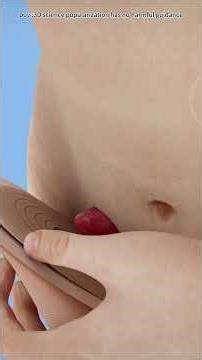 Colostomy (3D Animation)#Colostomy #IBD #ColonCancer #OstomyLife #SurgeryRecovery