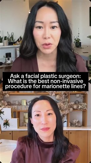 AIREM: Clinical K-Beauty® Aesthetic Spa & Plastic Surgery on Instagram: "There’s no single “best” treatment for marionette lines or nasolabial folds. The key is choosing the right approach and applying it with precision.⁠ ⁠ At AIREM, we don’t treat dermal filler as an all-or-nothing solution. When used strategically in microdroplets and placed with intention, filler remains one of the most effective tools for softening folds in the lower face.⁠ ⁠ Much of the conversation around “filler fatigue” 