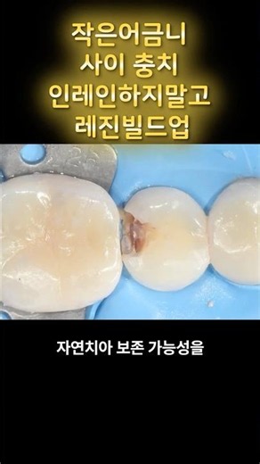 치아 사이 숨은 충치, 무조건 인레이 해야 할까? #인접면충치 #레진빌드업 #어금니충치레진