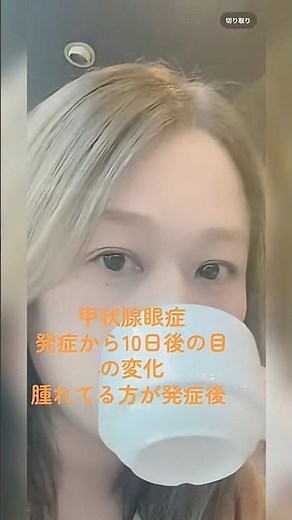 【バセドウ病】アイソトープ後甲状腺眼症になって治療開始１０日後の目の変化です #50代 #バセドウ病 #甲状腺眼症#病院
