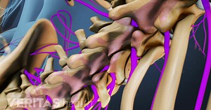 Cauda Equina Syndrome Video