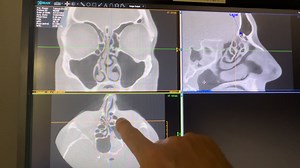 Reading Sinus CT For Fungal Sinusitis