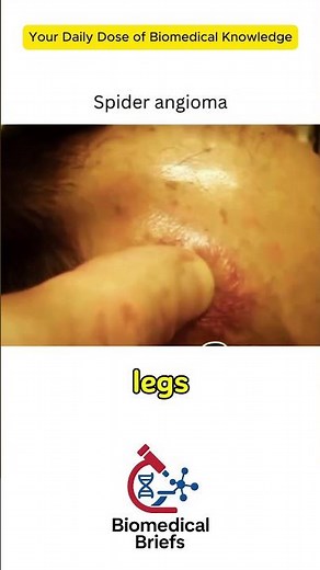 Spider Angioma 🕷️ | Why These Red Spots Appear #MedicalFacts #SpiderAngioma #BioMedicalBriefs