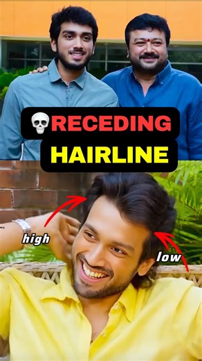 Soln For Receding HairLine✨ #Shorts #Short #Trending #AswinC #Lifestyle #Beautytip #Malayalam
