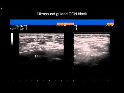 Ultrasound guided greater occipital nerve block