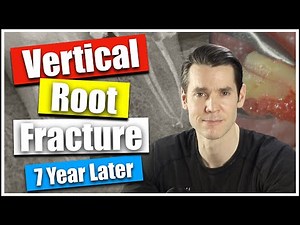 Vertical Root Fracture Diagnosed 7 Years Later • Video • MEDtube.net