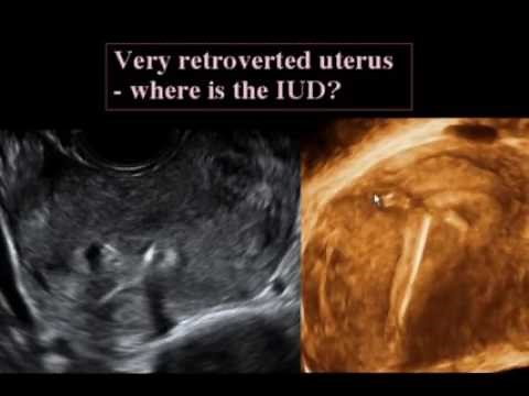What’s New in 3D Ultrasound of the Pelvis