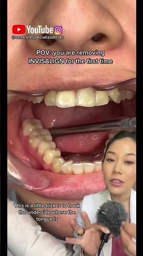 Trick to remove Invisalign. #invisalign #retainers #dentist #braces