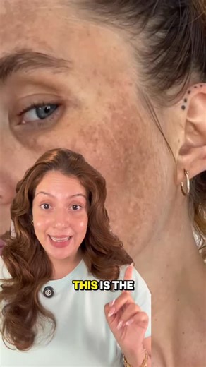 Nipun Kapur Sohal | Skincare Educator on Instagram: "Pregnancy safe skincare routine for pigmentation & melasma AM routine 7x week 1. Cleanse 2. Caudalie Vinoperfect 3. Moistuser 4. Mineral sunscreen PM Routine (upto 4x week) 1. double cleanse 2. Anua azelaic acid serum 3. Moisturiser ✅ SAFE Ingredients During Pregnancy • Hyaluronic Acid • Glycerin • Ceramides • Squalane • Niacinamide • Vitamin C (Ascorbic Acid) • Azelaic Acid • Centella Asiatica (Cica) • Allantoin • Panthenol • Peptides • Amino