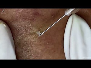 Big Cystic Acne Blackheads Extraction Blackheads & Milia, Whiteheads Removal Pimple Popping
