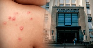 Perú se convierte en el país con la mayor tasa de viruela del mono en Latinoamérica