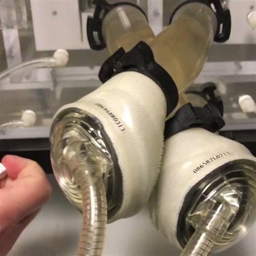 Sound on 🔊This is not an LVAD. This is a Total Artificial Heart.⚫Replaces both ventricles⚫Delivers pulsatile flow (~7–9 L/min)🌑Used as a bridge to transplant in advanced biventricular failure