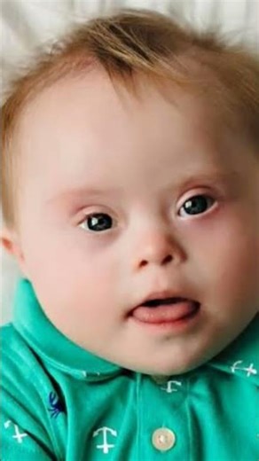 #Down syndrome #Treatment