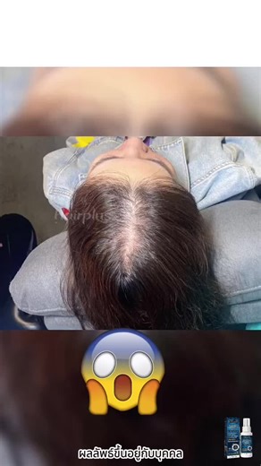 เ* ช่วยปลูกขนคิ้ว ปลูกหนวด เครา จอน และช่วยปลูกผม ลดผมร่วง เร่งขนคิ้วให้ดกดำ#ผมร่วง #ผมบาง #หัวล้าน #หัวเถิก #คิ้วบาง #ปลูกผม #ปลูกคิ้ว #ผมมัน #เชื้อรา #ล้านกรรมพันธุ์ #ลดผมหงอก #ลดผมร่วง #แชมพูปลูกผม#เซรั่มปลูกผม #yirenti