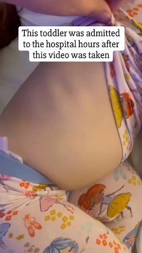 DID YOU GUESS? ➡️ Intercostal retractions! They occur when the muscles between the ribs (intercostal muscles) pull inward during breathing. This toddler was admitted hours after this video was taken. ‼️Pay attention- the RATE isn’t extremely fast, so some parents could easily miss the distress. ➡️ How else can we tell if our children are struggling to breathe? 🚩Nasal flaring 🚩 Retractions (visible pulling in of chest/neck muscles- look closely in video) 🚩 Head bobbing in young infants 🚩 Rapi
