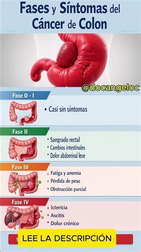 CANCER DE COLON Y SUS FASES: SINTOMAS QUE NO DEBES IGNORAR
