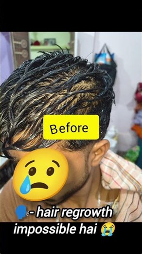 How to regrowth hair | which minoxidil is best? | #hairfall #hair #regrowhair #shorts #minoxidil