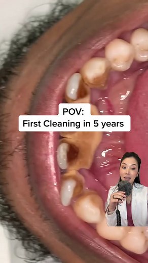 Dentistry Explained Episode 989 | When a patient hasnt gotten a cleaning in awhile, plaque can calcify into tartar. The pattern jt leaves behind shows that the amiunt of calculus that forms on behind the lower bottom is more than in many other areas. If you have been wondering this, it’s because of a salivary duct! Creator credit: @doktergigi_ #dentist #tartar #hygienetok