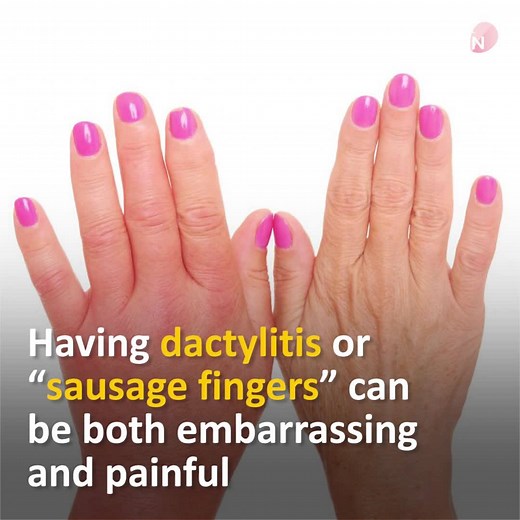 Sausage fingers or dactylitis can become a debilitating condition if the inflammation is severe enough to cause intense pain when moving the fingers or toes. Here are some treatment options.Sausage fingers or dactylitis can become a debilitating condition if the inflammation is severe enough to cause intense pain when moving the fingers or toes. Here are some treatment options. ~ Join our Facebook support group for Health for All Women to share tips and experience: https://www.facebook.com/group