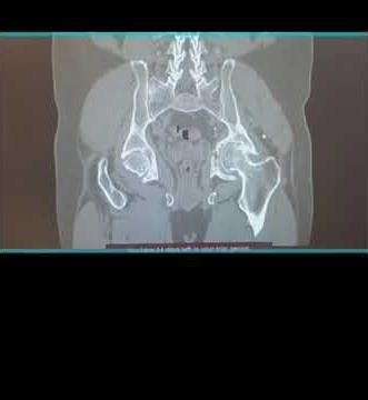 Protrusio Acetabuli with Acetabular Fracture