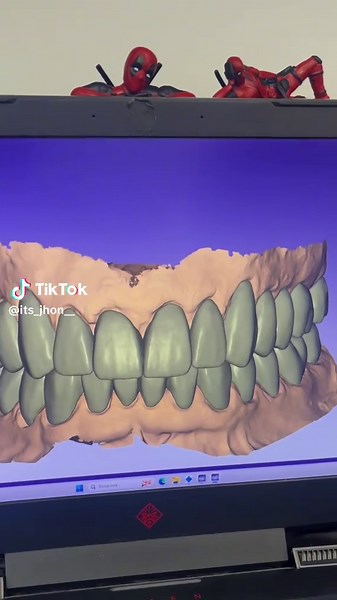 Diseño y Impresión de Carillas Dentales en Exocad