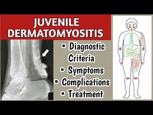 Juvenile Dermatomyositis Symptoms, Diagnostic Criteria, Complications, and Treatment