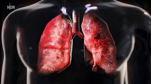 26K views · 75 reactions | Bei der COPD fällt das Atmen schwer. Oft erwischt es Raucher. Und das passiert dabei in der Lunge: | ARD GESUND | Facebook