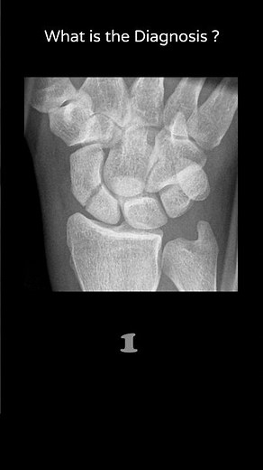 Scaphoid fracture - (Ulnar deviation view) 89 Trauma X-ray Upper limb Wrist #@radiologychannel007