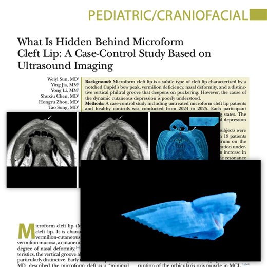 Why does the philtral groove in microform cleft lip deepen when puckering? A new PRS Journal study used ultrasound MRI and found a distinct subcutaneous “band” in 95% of patients—confirmed by pathology. Ultrasound may help diagnosis. 👉 Read the results: https://bit.ly/HiddenMicroform #PRSJournal #PlasticSurgery #CleftLip #MicroformCleftLip #CraniofacialSurgery #PediatricPlasticSurgery #Ultrasound #MedicalImaging #MRI #FacialAnatomy #ClinicalResearch #EvidenceBasedMedicine #ReconstructiveSurgery