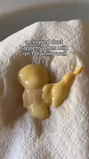 Nursing mamas, when your breast feels like it’s harboring a pea‑size rock of protest — that might be a clogged duct. 😣 A bit of inflammation around a milk duct (not always a literal “plug”) can block flow, causing soreness, swelling, or reduced output. The good news? It’s often treatable at home. Warm (not hot) showers, gentle breast compressions, different nursing positions, and checking flange fit can all help move things along. Sunflower lecithin is also used by many mamas as a tool to keep 