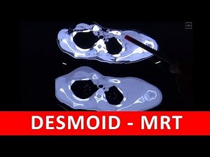 Desmoid - CT und MRT Analyse - by Radiologie TV