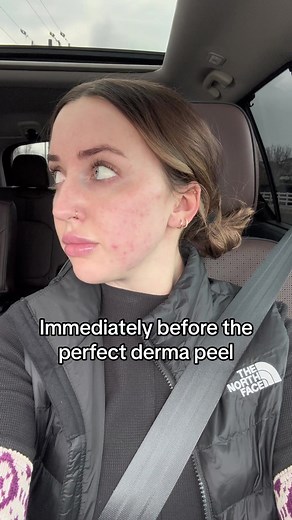 DISCLAIMER: i finish peeling a LOT faster than most people, largely due to the fact that my skin is well prepped from using tretinoin daily and receiving regular medical grade peels and treatments. That being said, this right here is why i am a huge proponent of the perfect derma peel. Great results in half the downtime.