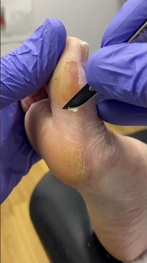 Dive into the satisfaction of thick callus removal. Watch an Aussie podiatrist work wonders!