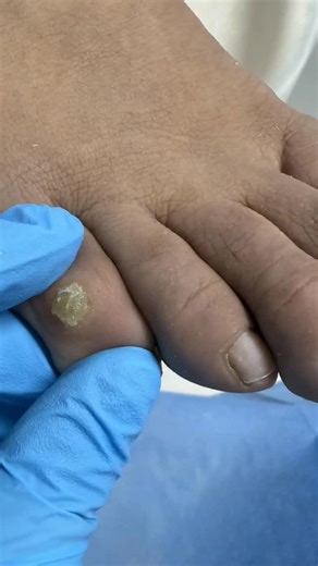 Professional podo care is more than a treatment,it’s guidance, relief, and prevention. During this appointment we focused on: • Careful removal of corn and callus on the 5th toe • Explaining how to cut toenails correctly to avoid pressure and ingrowns • Tamponade installation to reduce discomfort and protect the nail fold • Cleaning rough skin and sling areas • Preparing the nails properly so future results are safer and longer-lasting 👉 Want relief and a plan so it doesn’t keep coming back? Me